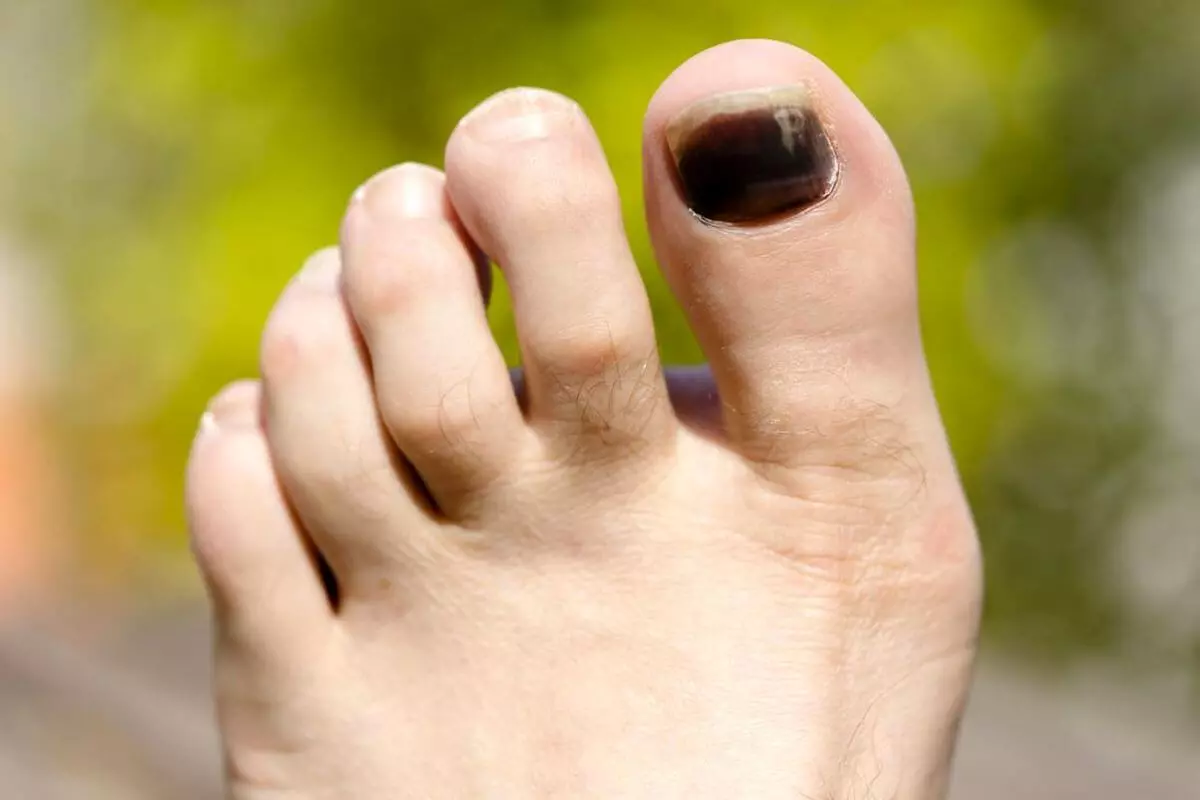 Грибковые заболевания ногтей